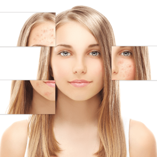 • STOP ACNEE Tratament anti-acneic și revitalizare-Protocol phitopeeling