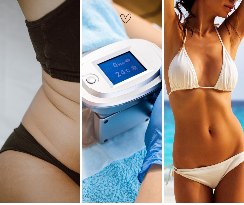 Slăbire prin criolipoliza tehnologie estetică de ultimă generație