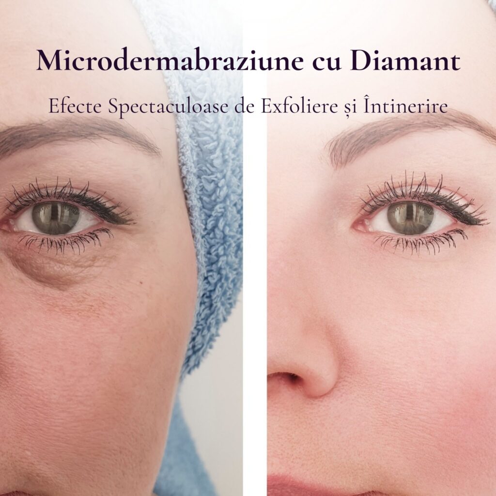 Microdermabraziune cu diamant – tratament facial la DermaSkin Galați