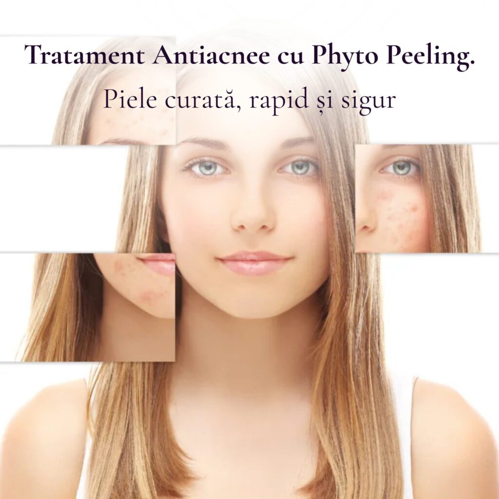 tratament antiacnee tratament cu phyto peeling