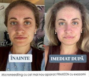 Față înainte și imediat după microneedling Fraxeen la DermaSkin Galați, piele mai netedă cu ușoară roșeață normală