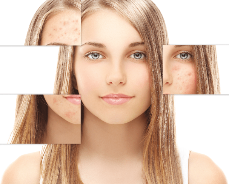 • STOP ACNEE Tratament anti-acneic și revitalizare-Protocol phitopeeling